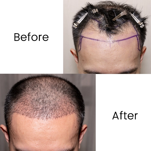 Activated Follicular Transplant Before and After Result in VCare